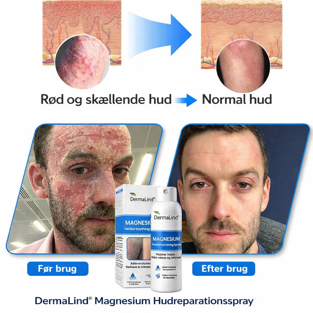 DermaLind™ - Magnesium Hudreparerende Spray til Sensitiv og Irriteret Hud - Image 4