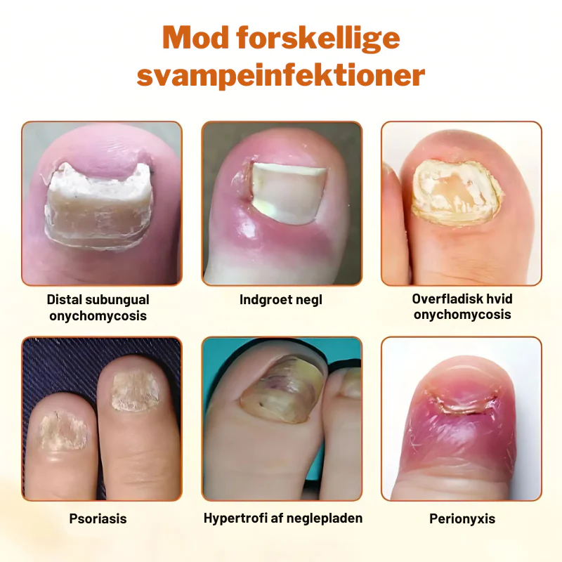 KlarNegl™ – Avanceret Svampedræbende Negleplejespray - Image 6