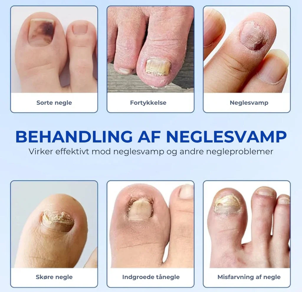 NegleFix™ – Svampedræbende Negleplaster til Sundere Negle - Image 3