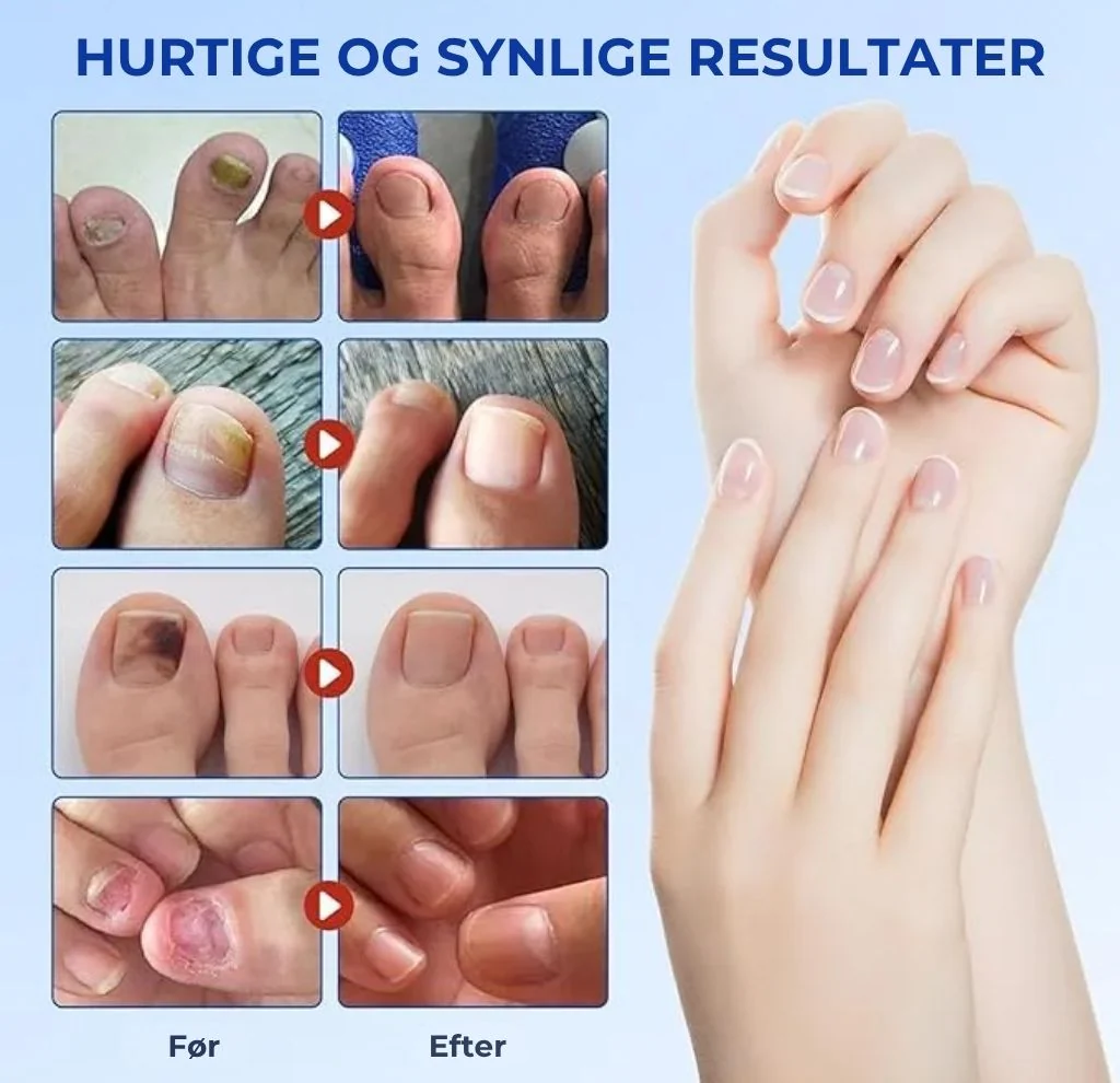 NegleFix™ – Svampedræbende Negleplaster til Sundere Negle - Image 5