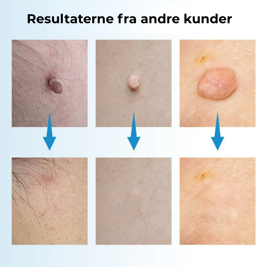 SkinEase™ Pen – Sikker fjernelse af hudmærker! - Image 4