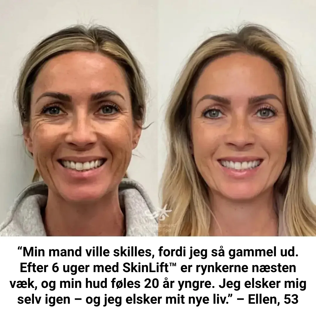 SkinLift™ Botox Serum - Synligt yngre hud på 14 dage. - Image 11