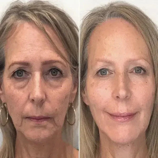 SkinLift™ Botox Serum - Synligt yngre hud på 14 dage. - Image 3