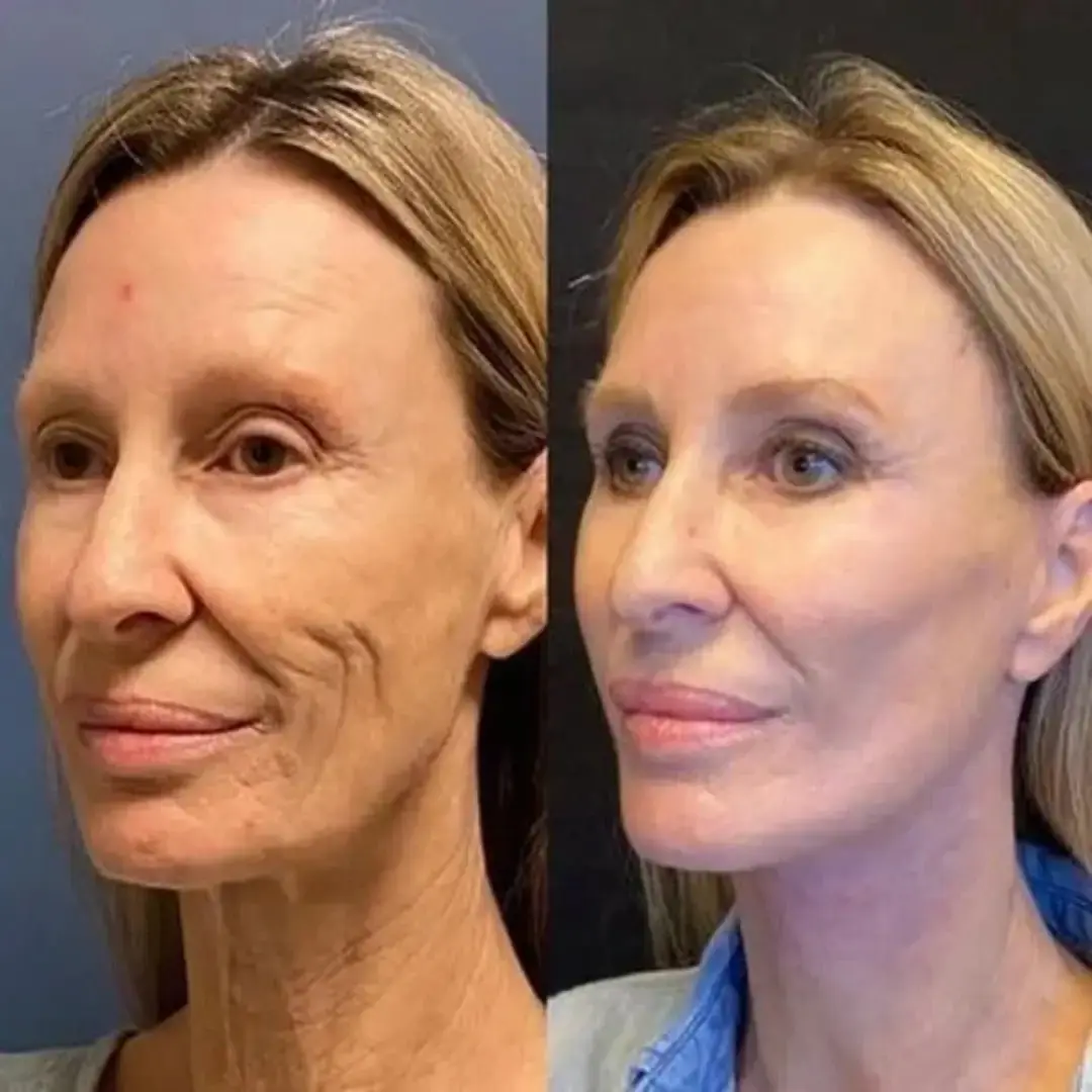 SkinLift™ Botox Serum - Synligt yngre hud på 14 dage. - Image 4