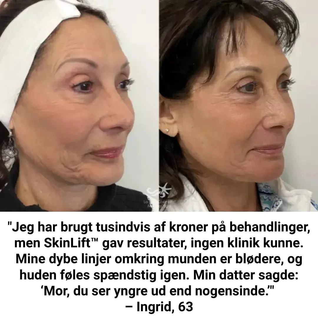 SkinLift™ Botox Serum - Synligt yngre hud på 14 dage. - Image 7