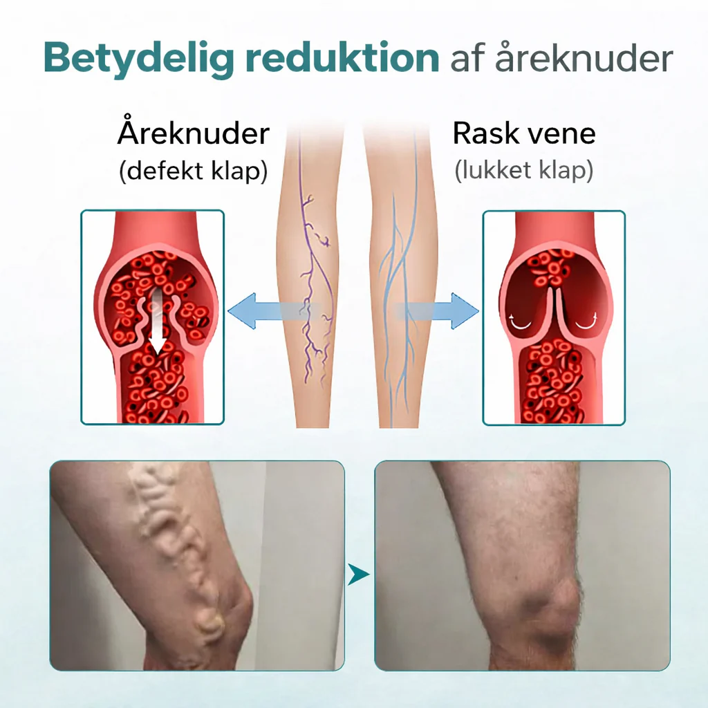 VenaLindre™ – Micronåle-patch til støtte for vener og lindring af tunge ben - Image 3